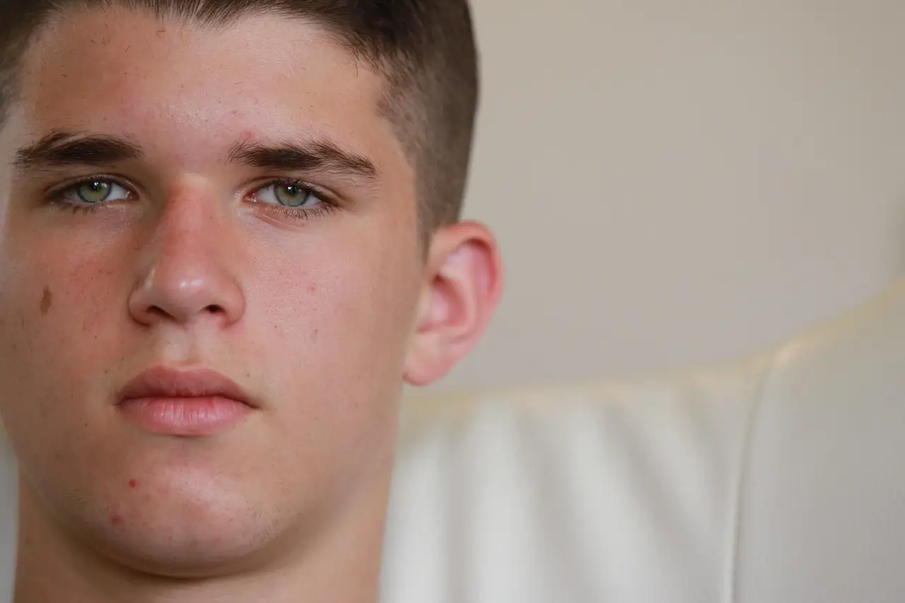 Acne: Why treatment can fail – and how to improve outcomes - Pulse Today